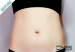 liposuction