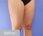 liposuction