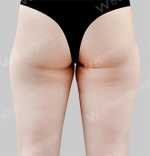 liposuction