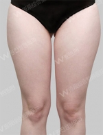 liposuction