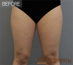 liposuction