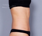 liposuction