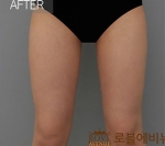 liposuction