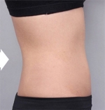 liposuction