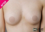 breast