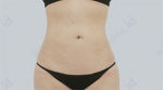 liposuction