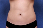 liposuction