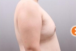 liposuction