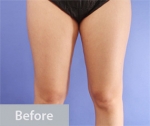 liposuction