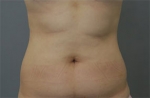 liposuction