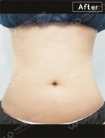 liposuction