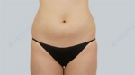 liposuction