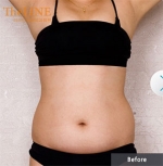 liposuction