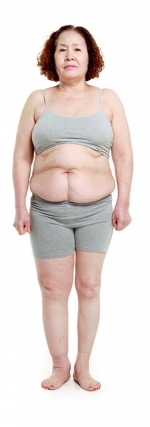 liposuction