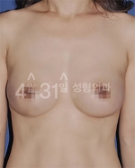 breast