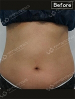 liposuction