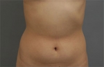 liposuction