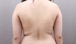 liposuction