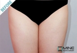 liposuction