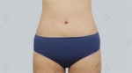 liposuction