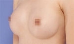 breast