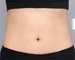 liposuction