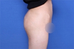 liposuction