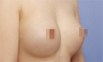 breast