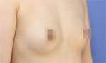 breast