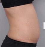 liposuction