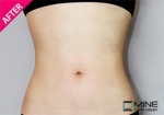 liposuction