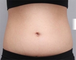 liposuction