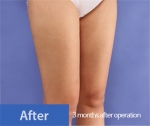 liposuction