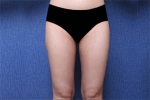 liposuction