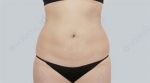 liposuction