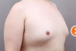 liposuction