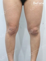 liposuction