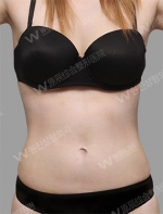 liposuction