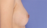 breast