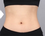 liposuction