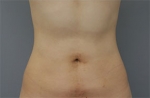 liposuction