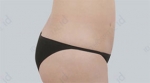 liposuction