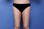 liposuction