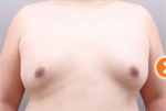 liposuction