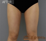 liposuction