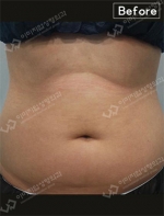 liposuction