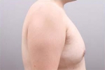 liposuction