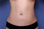 liposuction