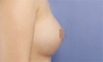 breast