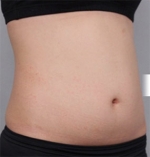 liposuction